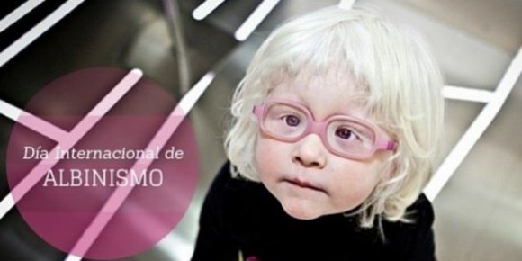 ¿Qué sabemos del Albinismo?
