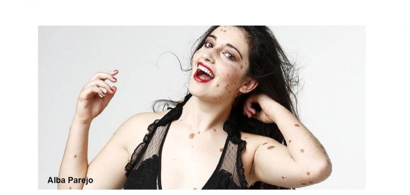 Testimonio de Inmaculada Esteban, mamá de una niña con Nevus Gigante Congénito